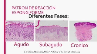 PATRON DE REACCION
ESPONGIFORME
Agudo Subagudo Cronico
J. E. Calonje ,T.Brenn et al, McKee's Pathology of the Skin, 4th Edition.2011
 