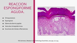 REACCION
ESPONGIFORME
AGUDA.
■ Ortoqueratosis
■ Espongiosis
■ Edema de dermis papilar.
■ Vesiculas intraepidermicas
■ Exocitosis de Celulas inflamatorias
R.B Johnston,Weedon's Skin Pathology Essentials, 2011 pp; 121-153.
 