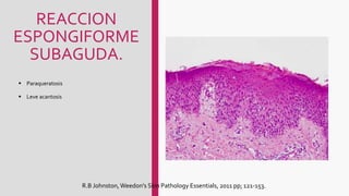 REACCION
ESPONGIFORME
SUBAGUDA.
 Paraqueratosis
 Leve acantosis
R.B Johnston,Weedon's Skin Pathology Essentials, 2011 pp; 121-153.
 
