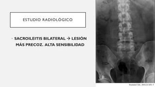 ESTUDIO RADIOLÓGICO
• SACROILEITIS BILATERAL → LESIÓN
MÁS PRECOZ. ALTA SENSIBILIDAD
 