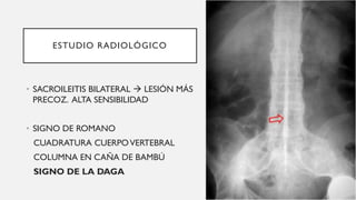ESTUDIO RADIOLÓGICO
• SACROILEITIS BILATERAL → LESIÓN MÁS
PRECOZ. ALTA SENSIBILIDAD
• SIGNO DE ROMANO
CUADRATURA CUERPOVERTEBRAL
COLUMNA EN CAÑA DE BAMBÚ
SIGNO DE LA DAGA
 