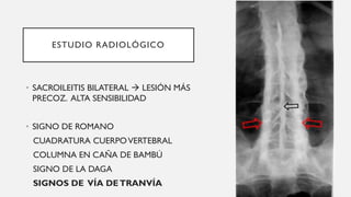 ESTUDIO RADIOLÓGICO
• SACROILEITIS BILATERAL → LESIÓN MÁS
PRECOZ. ALTA SENSIBILIDAD
• SIGNO DE ROMANO
CUADRATURA CUERPOVERTEBRAL
COLUMNA EN CAÑA DE BAMBÚ
SIGNO DE LA DAGA
SIGNOS DE VÍA DETRANVÍA
 