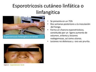 Esporotricosis cutáneo linfática o
                   linfangitica
                                       • Se presenta en un 75%
                                       • Dos semanas posteriores a la inoculación
                                         del hongo.
                                       • Forma un chancro esporotricósico,
                                         constituido por un ligero aumento de
Esporotricosis linfangítica en brazo     volumen, eritema y lesiones
                                         nodogomosas, así como ulceras.
                                       • Lesiones no dolorosas y rara vez prurito.
 