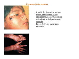 • A partir del chancro se forman
  gomas, grandes placas con
  costras sanguineas y melicéricas
  rodeado de un halo eritemato-
  violáceo.
• Se puede limitar a una lesión
  verrugosa
 