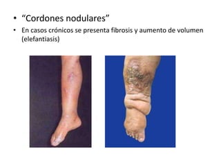 • “Cordones nodulares”
• En casos crónicos se presenta fibrosis y aumento de volumen
  (elefantiasis)
 