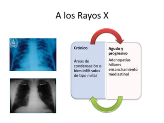 A los Rayos X


    Crónico            Agudo y
                       progresivo
    Áreas de           Adenopatías
    condensación o     hiliares
    bien infiltrados   ensanchamiento
    de tipo miliar     mediastinal
 