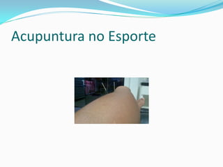 Acupuntura no Esporte
 