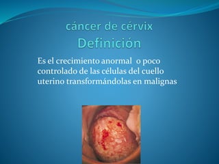 Es el crecimiento anormal o poco
controlado de las células del cuello
uterino transformándolas en malignas