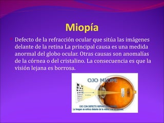 Miopía
 Defecto de la refracción ocular que sitúa las imágenes
 delante de la retina La principal causa es una medida
 anormal del globo ocular. Otras causas son anomalías
 de la córnea o del cristalino. La consecuencia es que la
 visión lejana es borrosa.
 