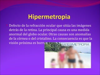 Hipermetropia
 Defecto de la refracción ocular que sitúa las imágenes
 detrás de la retina. La principal causa es una medida
 anormal del globo ocular. Otras causas son anomalías
 de la córnea o del cristalino. La consecuencia es que la
 visión próxima es borrosa.
 