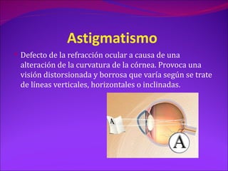 Astigmatismo
 Defecto de la refracción ocular a causa de una
 alteración de la curvatura de la córnea. Provoca una
 visión distorsionada y borrosa que varía según se trate
 de líneas verticales, horizontales o inclinadas.
 