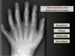 ¿Cómo se le llama a esta
malformación de la mano?

Aneurisma
Cifosis
Polidactilia
Sarcoidosis

 
