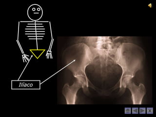 Ilíaco



         X
 