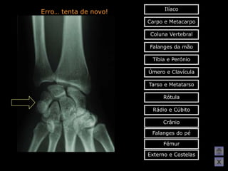 Ilíaco
Erro… tenta de novo!
                       Carpo e Metacarpo

                        Coluna Vertebral

                       Falanges da mão

                        Tíbia e Perónio

                       Úmero e Clavícula

                       Tarso e Metatarso

                            Rótula

                        Rádio e Cúbito

                            Crânio

                        Falanges do pé

                            Fémur

                       Externo e Costelas
                                            X
 