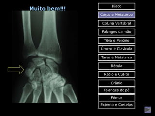 Ilíaco
Muito bem!!!
               Carpo e Metacarpo

                Coluna Vertebral

               Falanges da mão

                Tíbia e Perónio

               Úmero e Clavícula

               Tarso e Metatarso

                    Rótula

                Rádio e Cúbito

                    Crânio

                Falanges do pé

                    Fémur

               Externo e Costelas
 