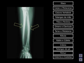 Ilíaco

Carpo e Metacarpo

 Coluna Vertebral

Falanges da mão

 Tíbia e Perónio

Úmero e Clavícula

Tarso e Metatarso

     Rótula

 Rádio e Cúbito

     Crânio

 Falanges do pé

     Fémur

Externo e Costelas
                     X
 