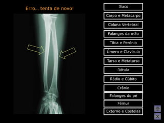 Ilíaco
Erro… tenta de novo!
                       Carpo e Metacarpo

                        Coluna Vertebral

                       Falanges da mão

                        Tíbia e Perónio

                       Úmero e Clavícula

                       Tarso e Metatarso

                            Rótula

                        Rádio e Cúbito

                            Crânio

                        Falanges do pé

                            Fémur

                       Externo e Costelas
                                            X
 