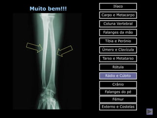 Ilíaco
Muito bem!!!
               Carpo e Metacarpo

                Coluna Vertebral

               Falanges da mão

                Tíbia e Perónio

               Úmero e Clavícula

               Tarso e Metatarso

                    Rótula

                Rádio e Cúbito

                    Crânio

                Falanges do pé

                    Fémur

               Externo e Costelas
 