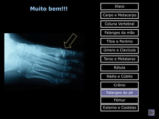 Ilíaco
Muito bem!!!
               Carpo e Metacarpo

                Coluna Vertebral

               Falanges da mão

                Tíbia e Perónio

               Úmero e Clavícula

               Tarso e Metatarso

                    Rótula

                Rádio e Cúbito

                    Crânio

                Falanges do pé

                    Fémur

               Externo e Costelas
 