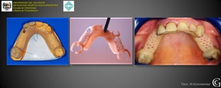 UNIVERSIDAD DEL SALVADOR
ASOCIACION ODONTOLOGICAARGENTINA
Escuela de Odontología
Cátedra de Prostodoncia I
Técn. M.Kommendat