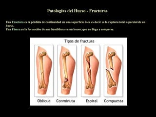 Patologías del Hueso - Fracturas

Una Fractura es la pérdida de continuidad en una superficie ósea es decir es la ruptura total o parcial de un
hueso.
Una Fisura es la formación de una hendidura en un hueso, que no llega a romperse.
 