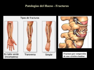 Patologías del Hueso - Fracturas




                            Fractura por compresión
                            de una vértebra lumbar
 