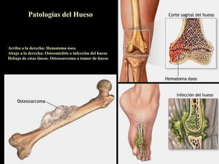 Patologías del Hueso



Arriba a la derecha: Hematoma óseo.
Abajo a la derecha: Osteomielitis o infección del hueso
Debajo de estas líneas. Osteosarcoma o tumor de hueso
 