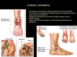 Lesiones Articulares

 Un Esguince es la torcedura violenta y dolorosa de una articulación.
 Una Luxación es la dislocación o salida de lugar de un hueso, de carácter
 menos grave que la fractura.
 Imágenes de la Izquierda: Luxación de tobillo (arriba), Cadera y
 Hombro (abajo).
 Imagen de la derecha: Esguince con estiramiento (distensión) de los
 ligamentos.
 