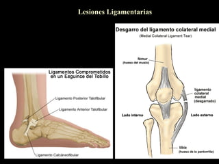 Lesiones Ligamentarias
 
