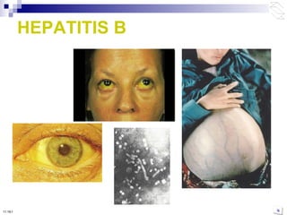 HEPATITIS B 10:50 PM 