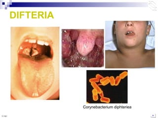 DIFTERIA Corynebacterium diphteriea 10:50 PM 