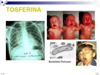 TOSFERINA Bordetella Pertussis 10:50 PM 