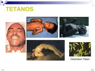 TETANOS Clostridium Tetani 10:50 PM 