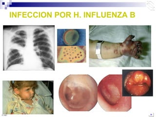INFECCION POR H. INFLUENZA B 10:50 PM 