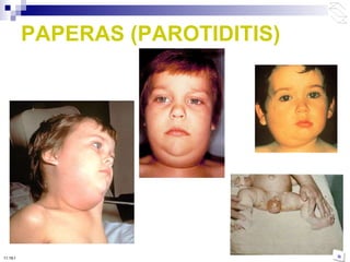 PAPERAS (PAROTIDITIS) 10:50 PM 