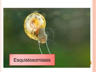 Esquistosomiasis 