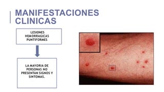 MANIFESTACIONES
CLINICAS
LESIONES
HEMORRAGICAS
PUNTIFORMES
LA MAYORIA DE
PERSONAS NO
PRESENTAN SIGNOS Y
SINTOMAS.
 