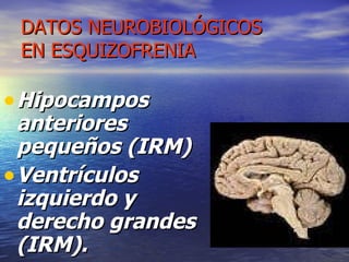 DATOS NEUROBIOLÓGICOS EN ESQUIZOFRENIA Hipocampos anteriores pequeños (IRM) Ventrículos izquierdo y derecho grandes (IRM). 