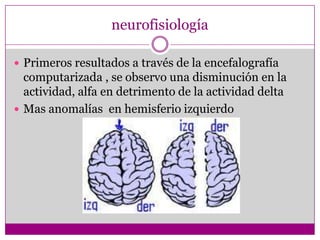 neurofisiologíaPrimeros resultados a través de la encefalografía computarizada , se observo una disminución en la actividad, alfa en detrimento de la actividad deltaMas anomalías  en hemisferio izquierdo