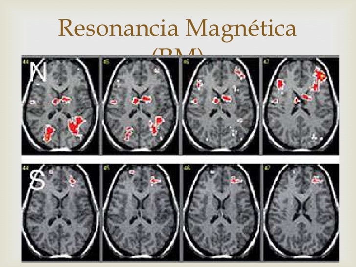 шизофрения мрт мозга. шизофрения мрт мозга. мозг человека больного шизофренией. мрт головного мозга больного шизофренией. шизофрения мрт мозга.