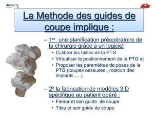 – 1er une planification préopératoire de
la chirurgie grâce à un logiciel
• Calibrer les tailles de la PTG
• Virtualiser le positionnement de la PTG et
• Proposer les paramètres de poses de la
PTG (coupes osseuses , rotation des
implants ,…)
– 2e la fabrication de modèles 3 D
spécifique au patient opéré :
• Fémur et son guide de coupe
• Tibia et son guide de coupe
La Methode des guides de
coupe implique :
 