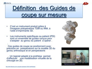 • C’est un instrument produit grâce à
l'imagerie préopératoire TDM ou IRM, à
l’aide d’imprimante 3D.
• Les instruments spécifiques au patient (PSI)
sont un ensemble de guides conçus pour
s'adapter au genou du patient à opérer .
.
Ces guides de coupe se positionnent avec
précision en préopératoire sur le modèle 3D du
genou arthrosique et en peropératoire
. Un logiciel adapté à la prothèse permet
d’effectuer une modélisation virtuelle de la
chirurgie en 3D.
Définition des Guides de
coupe sur mesure
http://www.fabulous.com.co/guide-impression-3d/en-bref/histoire/
 