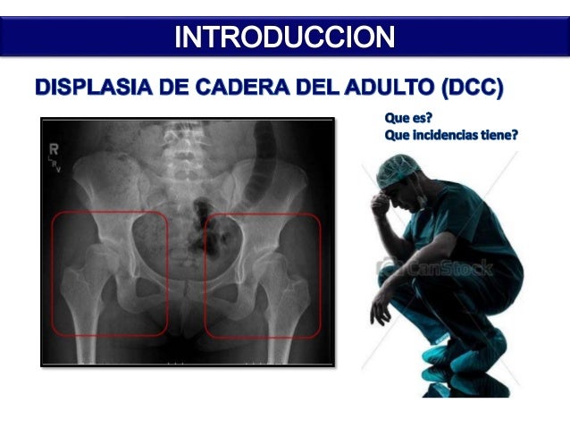ESSALUD DISPLASIA DE CADERA EN EL ADULTO JOVEN