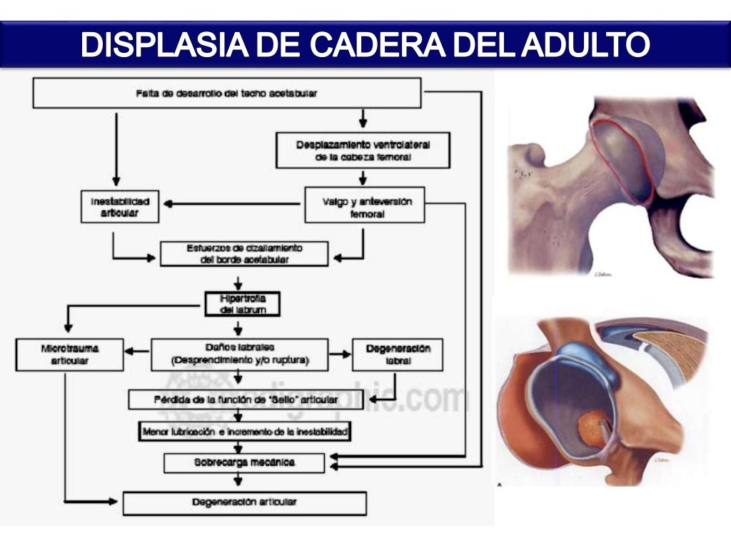 ESSALUD DISPLASIA DE CADERA EN EL ADULTO JOVEN