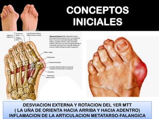DESVIACION EXTERNA Y ROTACION DEL 1ER MTT
( LA UÑA DE ORIENTA HACIA ARRIBA Y HACIA ADENTRO)
INFLAMACION DE LA ARTICULACION METATARSO-FALANGICA

 