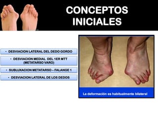 • DESVIACION LATERAL DEL DEDO GORDO
• DESVIACION MEDIAL DEL 1ER MTT
(METATARSO VARO)
• SUBLUXACION METATARSO – FALANGE 1
• DESVIACION LATERAL DE LOS DEDOS

 