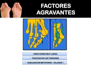 • DEDO GORDO MUY LARGO
• TRACCION DE LOS TENDONES
• SUBLUXACION METATARSO – FALANGE 1

 