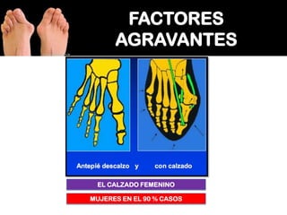 EL CALZADO FEMENINO

MUJERES EN EL 90 % CASOS

 