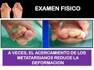 A VECES, EL ACERCAMIENTO DE LOS
METATARSIANOS REDUCE LA
DEFORMACION

 