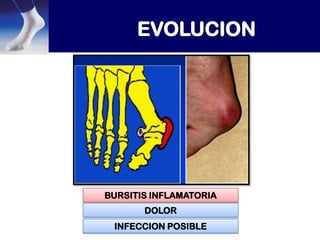BURSITIS INFLAMATORIA
DOLOR
INFECCION POSIBLE

 